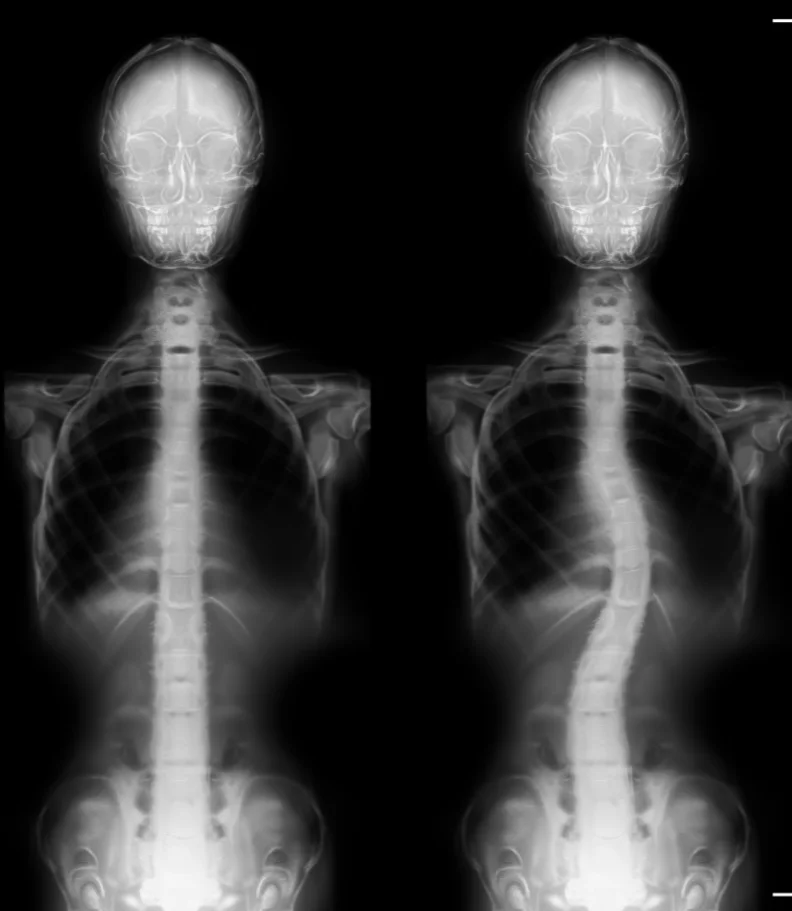 scoliosis Gilbert AZ